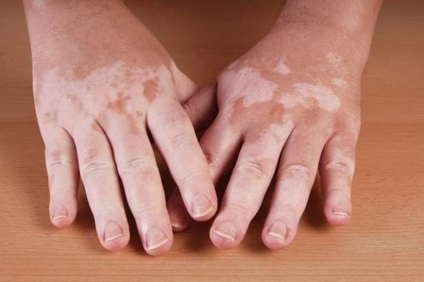 தோலின் நிறமிகள் இழக்கப்பட்டு வெள்ளையாக மாறும் 'vitiligo' நோய்க்கு நிவாரணம். Assurance maladie பச்சை கொடி.